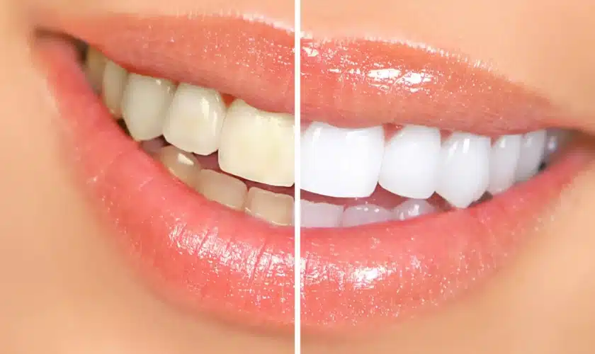 Teeth Whitening: What To Expect During And After Treatment