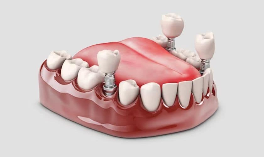 Dental Implants In Canton-Plymouth Family Dentistry Canton MI