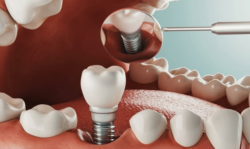 Navigating The Road After A Failed Dental Implant: A Comprehensive Guide