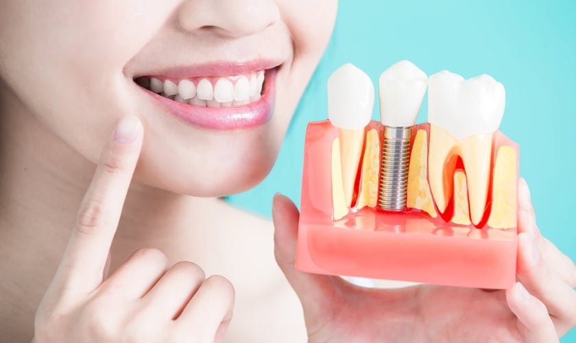 Dental Implants Canton