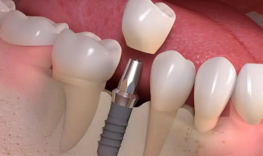 What steps are involved in getting dental implants