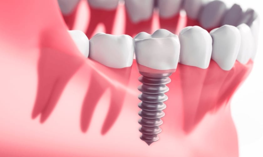 Why Dental Implants Are The Best Solution For Missing Teeth